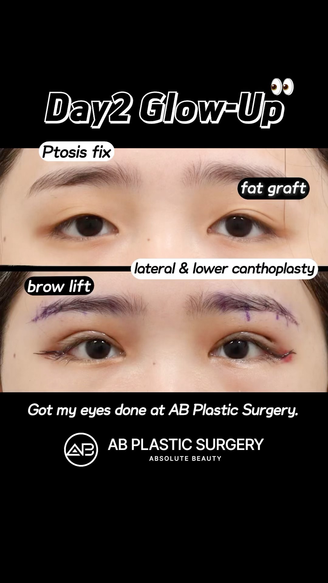 Only 2 Days After Eye Surgery in Korea?! #koreanplasticsurgery