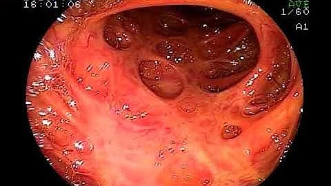 Pseudopolyposis with Ulcerative Colitis