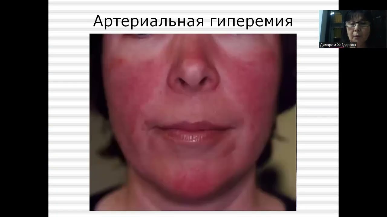 Нарушения периферического кровообращения