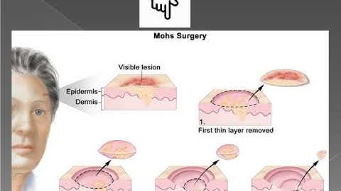 coding Tips for MOHS Surgery Integumentary system