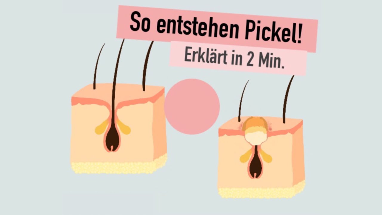 Warum Kommen Pickel Immer An Dergleichen Stelle So entstehen Pickel - erklärt in 2 Minuten / WOMANSKILLS - YouTube