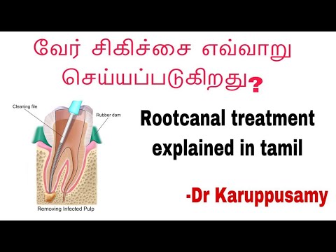 வேர் சிகிச்சை எவ்வாறு செய்யப்படுகிறது || வேர் (துளை )சிகிச்சை||ROOTCANAL TREATMENT EXPLAINED TAMIL