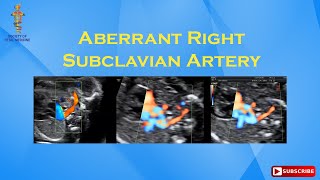 Aberrant Right Subclavian Artery