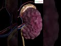 What Is Dialysis? | Kidney Treatment Explained by Dr. Akash Gupta