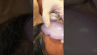 Botox com cuidado e precisão #dermatologia