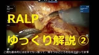 RALP　ゆっくり解説動画②　ロボット支援腹腔鏡下前立腺全摘除術