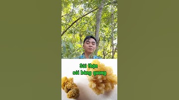 Sỏi thận sỏi bàng quang sỏi đường tiết niệu thì mọi người xem hết video này #soi #soithan