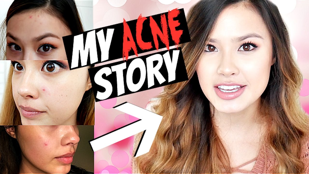 My Acne Story Effective Spot Treatment for Pimples & Breakouts The Beauty Breakdown - YouTube