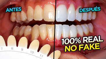 ¿Puede un dentista blanquear los dientes de forma permanente?