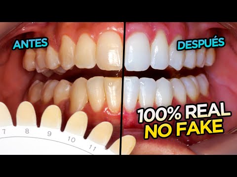 Video: 3 formas de blanquear los dientes en una hora