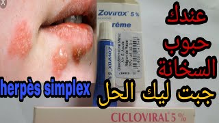 علاج فعال لحبوب السخانة حول الفم والأنف او مايسمى herpes