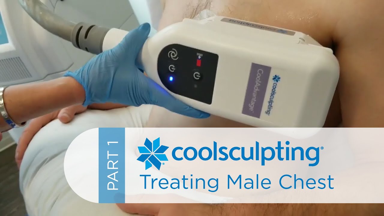 CoolSculpting Treatments for Men Male Chest (Part 1) YouTube