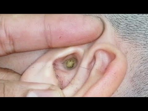 horrible ear wax in the boy