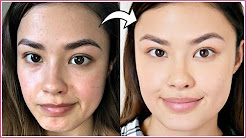 How I Manage My Breakouts (Skin Reactions) | My Experience with Allergic Reactions