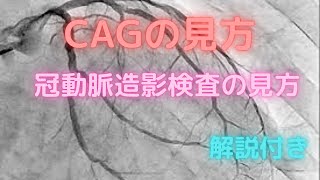 CAGの見方・冠動脈造影検査の見方