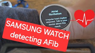 Samsung Smart watch  detects  Atrial fibrillation in 30 seconds - AFib irregular heartbeat by Rob Daman 348 views 1 month ago 5 minutes, 58 seconds