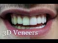 3d veneers get a beauty smile without damaging your teeth