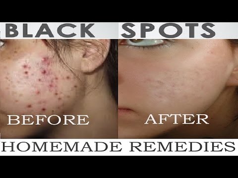 Clear Acne Marks | Dark scars | Pimple spots , Get Clean Face Skin  HOURS  POWER of MAKEUP