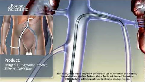 Quale antinfiammatorio per varicocele?