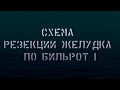 Схема резекции желудка по Бильрот I