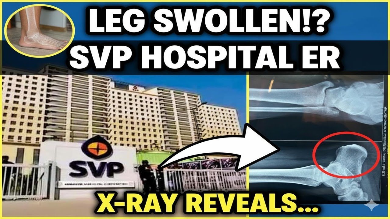 Leg Swollen?! My ER Visit & X-Ray at SVP Hospital (What Happened?!)