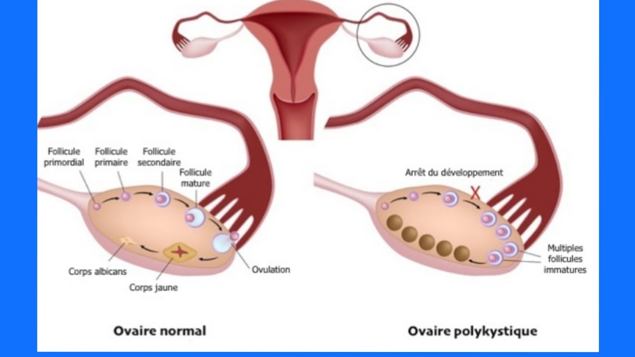 Овуляция при поликистозе