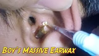 Boy's Massive Earwax Removal from Both Ears