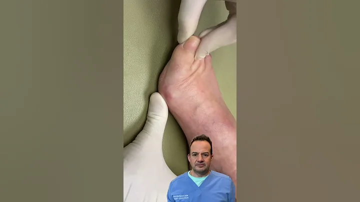 INSANE BUNION DISLOCATION!😱 #shorts