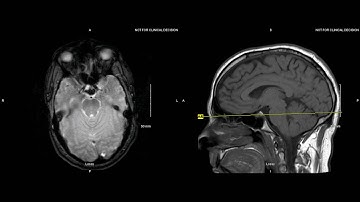Unremarkable Non Contrast Brain MRI: Axial Gradient Echo - Example 1
