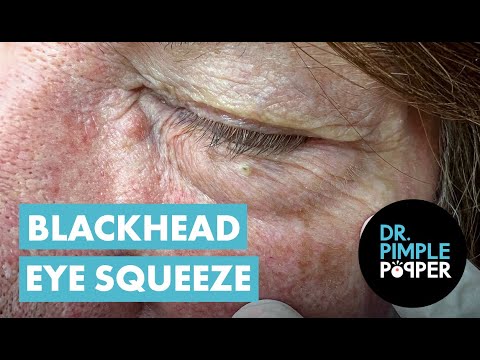 Blackhead Eye Squeeze