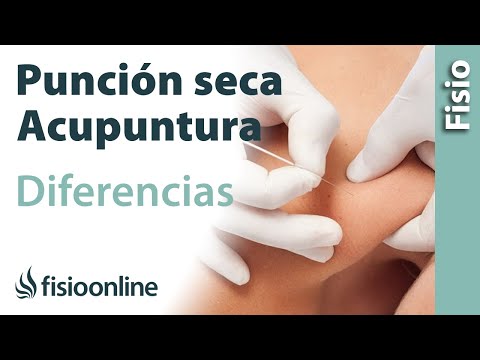 Vídeo: Aguja Seca Versus Acupuntura: Beneficios Y Riesgos