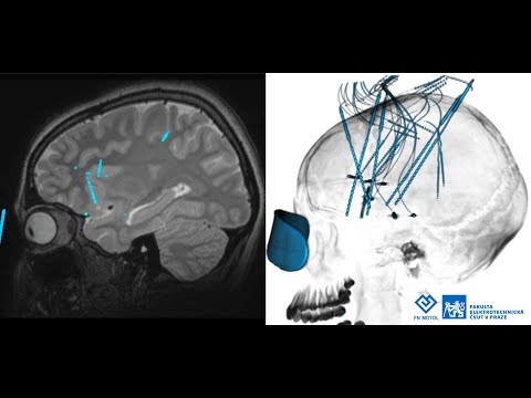 Video: Tourette Syndrom: Příznaky, Léčba A Diagnostika