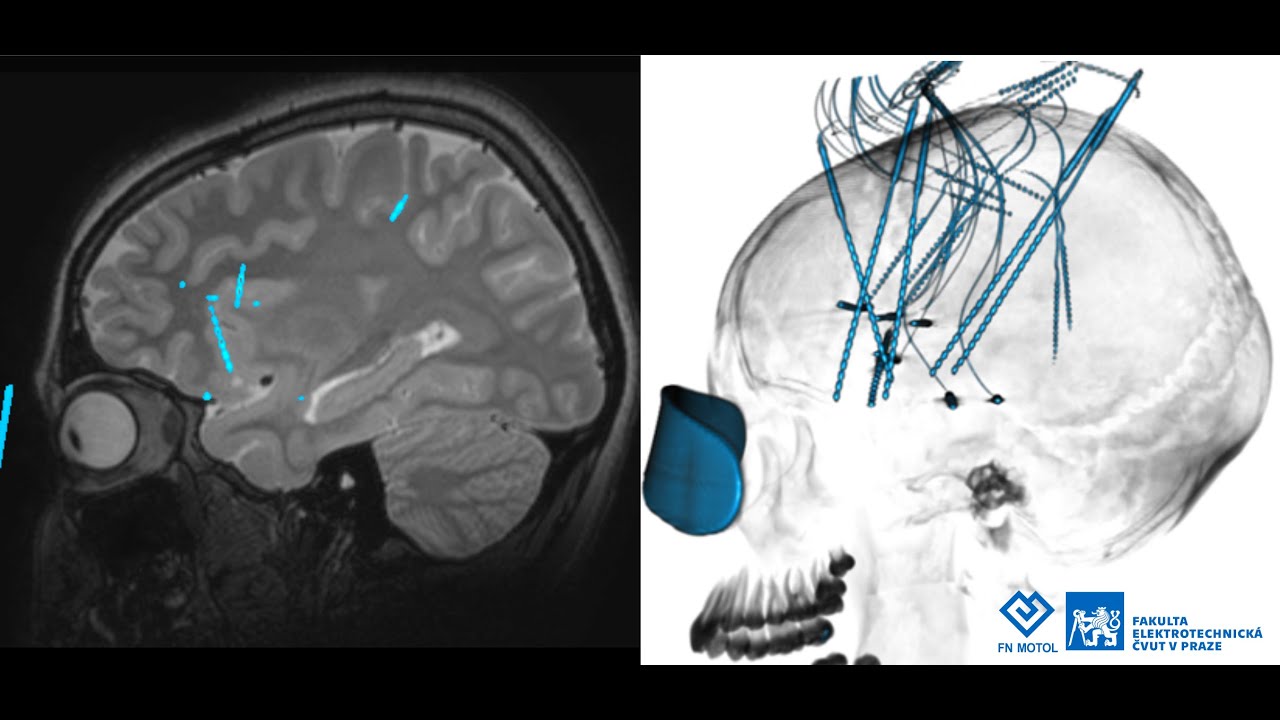 dr. Janča: Chirurgická léčba epilepsie a moderní trendy v její diagnostice [Týden mozku, on-line]