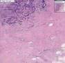 Histopathology breast ductal carcinoma