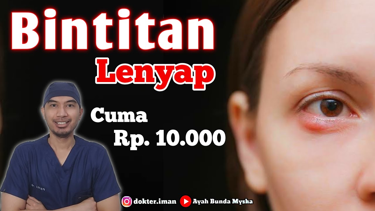 Cara Mengobati Mata Bintitan, Terjangkau dan Ampuh ‼️