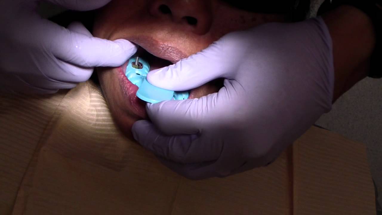 Dental Implant Open Tray Impression Technique How to YouTube