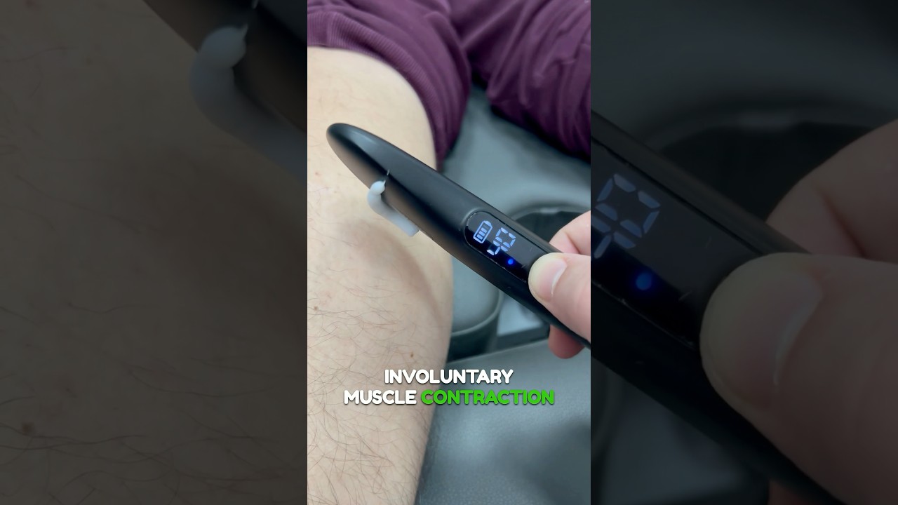 Benign fasciculation syndrome 