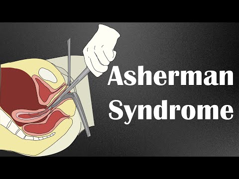 Видео: Мва Ашерманы синдром үүсгэж болох уу?