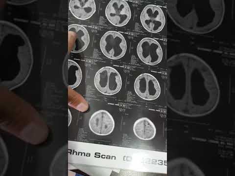 رد على كل من يقول الضمور ملوش علاج طفل بقى طبيعى مع انه ضمور بالمخ 01026261516