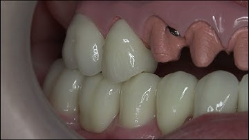 How to avoid occlusal interference
