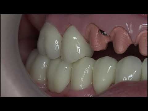 How to avoid occlusal interference
