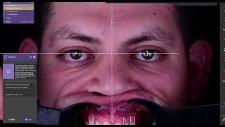 Diseño de sonrisa en Exocad