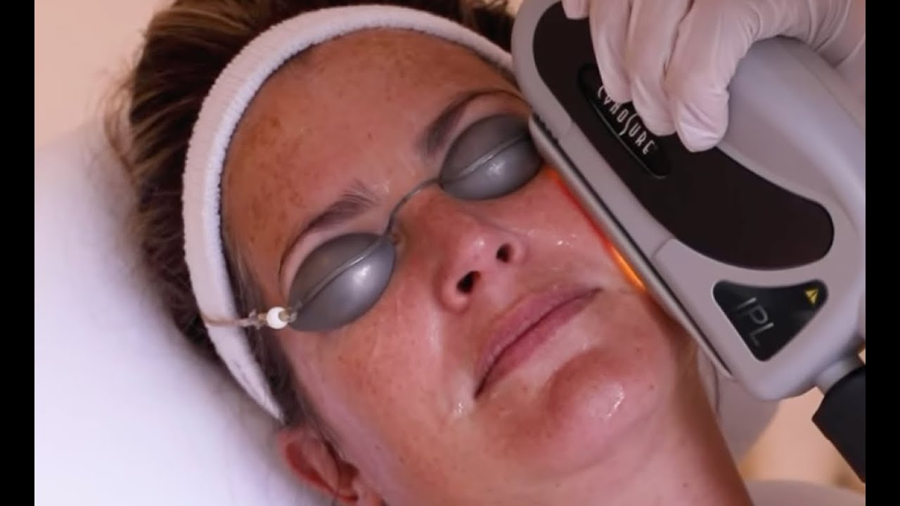 Huidverjonging met de Photo Facial / IPL