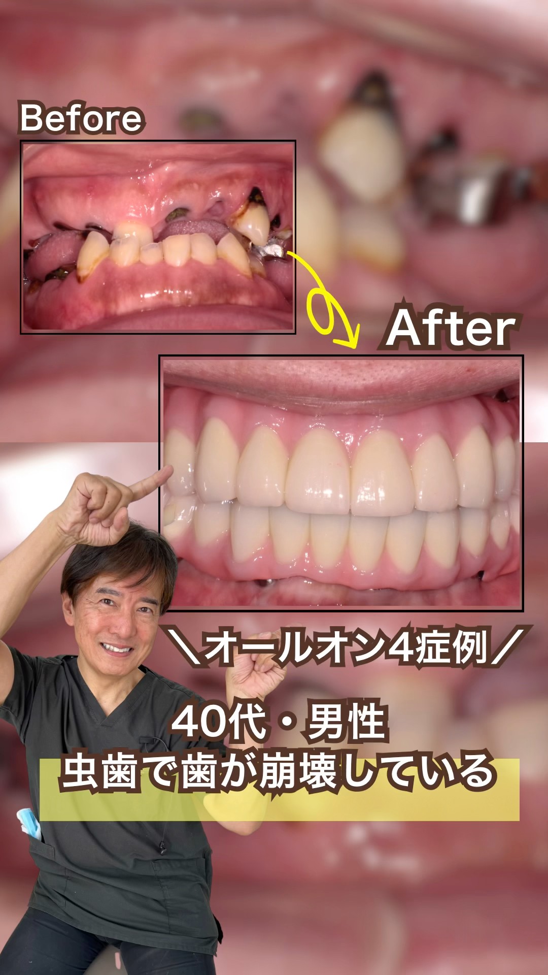 All-on-4 Case Study! 40-Year-Old Male with Severe Tooth Decay