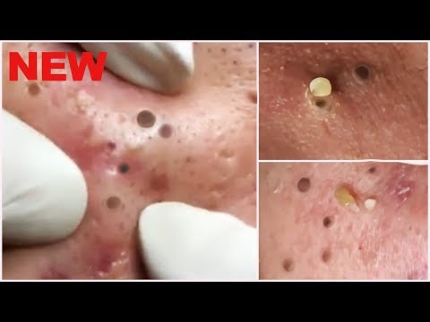 Deep Blackheads Removal from Cheeks and Nose - Best Pimple Popping Videos