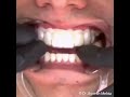 Instant permanent smile correction by dr jignesh mehta