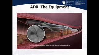 Antegrade Dissection/Re-entry: Step-by-Step - M. Nicholas Burke, MD