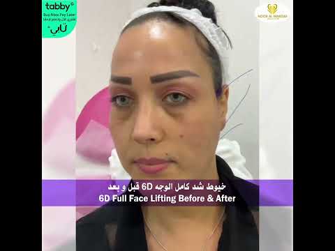 خيوط شد الوجه