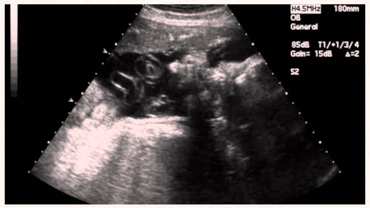 21 неделя беременности тянет. УЗИ на 38 неделе беременности. Снимки УЗИ на 38 неделе беременности. УЗИ 38 недель беременности фото.