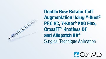Double Row Cuff Augmentation Using Y-Knot® PRO RC and Flex, CrossFT® Knotless DT, and Allopatch HD®